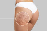 👙 Cellulite Reduction & Slimming | Arms & Legs