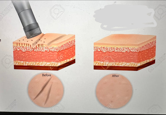 Mesotherapy | Fat Dissolver